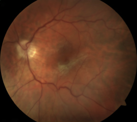 Epiretinal membranes can affect the macula, causing decreased central vision