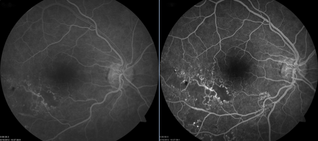 Fluorescein angiogram of retinal vein occlusion shows disruption of the normal blood flow