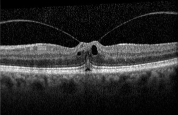 OCT of the macula reveals how the retina becomes distorted from vitreomacular traction