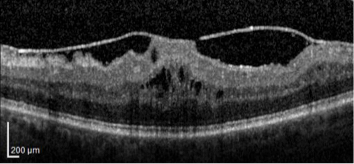 OCT scan of epiretinal membrane distorting the retinal structure