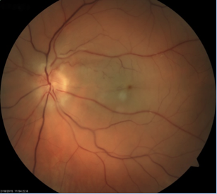 The retina becomes pale when the standard arterial blood flow is blocked