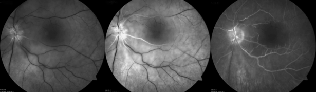 Fluorescein angiogram after retinal artery occlusion shows very poor blood flow to the retina
